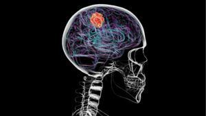 Beyin Kanseri, Kafatasının Bazı Kısımlarını Eritebilir!