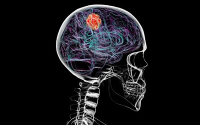 Beyin Kanseri, Kafatasının Bazı Kısımlarını Eritebilir!