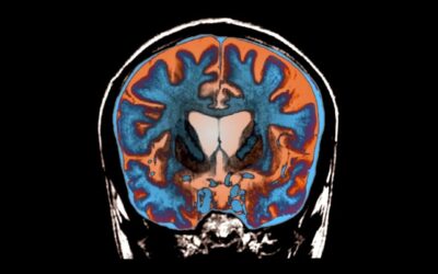 Deneysel Bir Tedavi İlk Kez Huntington Hastalığı’nın İlerlemesini Yavaşlattı!