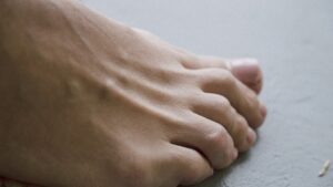 Diyabetik Ayak Nedir? Neden Gelişir, Nasıl Önlenir?