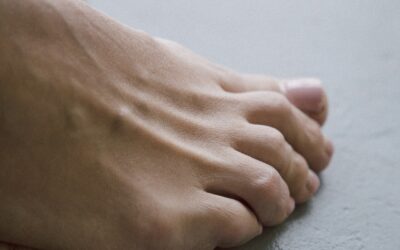 Diyabetik Ayak Nedir? Neden Gelişir, Nasıl Önlenir?