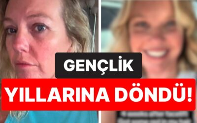 Yüz Gerdirme Yaptırdıktan Sonra Gençlik Yıllarına Dönen 45 Yaşındaki Kadının Son Hali Şaşırttı