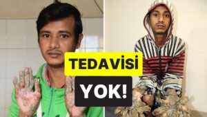Elleri ve Ayakları Anormal Bir Şekilde Kabuklanıyor: &quot;Ağaç Adam&quot; Olarak Bilinen Adamın Trajik Hayatı