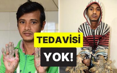 Elleri ve Ayakları Anormal Bir Şekilde Kabuklanıyor: &quot;Ağaç Adam&quot; Olarak Bilinen Adamın Trajik Hayatı