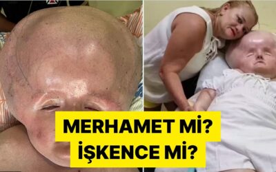 3 Ay Yaşaması Beklenen Oğluna 31 Yaşına Kadar Bakan Brezilyalı Anne Tartışma Yarattı