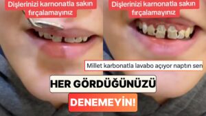 İnternette Her Gördüğünüzü Denemeyin! Bir Dişçi Dişini Karbonatla Fırçalayan Bir Hastanın Durumunu Paylaştı