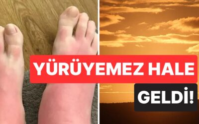 Zehirlendi! &quot;Yaz Tatilinin Şanındandır&quot; Diyerek Saatlerce Güneşlenen Turist Hayatının Kabusunu Yaşadı