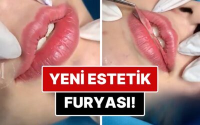 Yeni Estetik Trendi mi Doğuyor? &quot;Kalp Dudak&quot; Estetiği İçin Uygulanan Operasyon İçinizi Bi&apos; Tuhaf Yapacak!