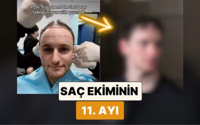 Bambaşka Biri Olmuş: Saç Ektiren İçerik Üreticisi Zeph Sanders 11 Ayda Saçlarının Geldiği Hali Paylaştı