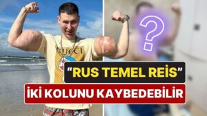 &quot;Rus Temel Reis&quot; İki Kolunu Kaybedebilir: Enjekte Ettiği Kimyasallar Hayatını Kararttı